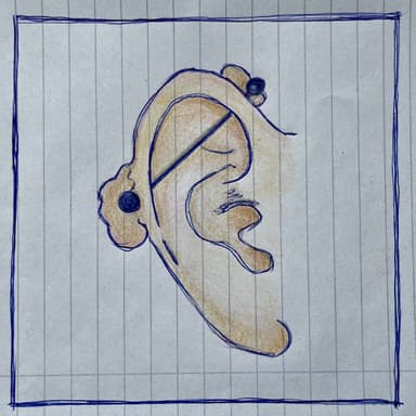 Hrčka kvôli piercingu alebo keloidná jazva